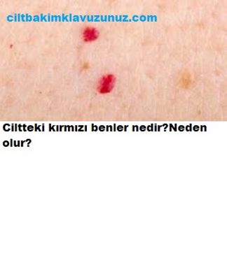 Read more about the article Ciltteki Kırmızı Benler Nedir Neden Oluşur