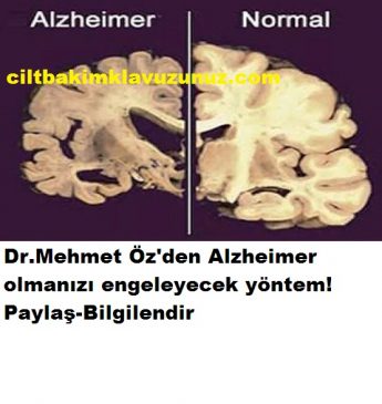 Read more about the article Doktordan  Tavsiye Bunu Yaparsanız Alzheimer Olmazsınız