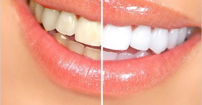 Read more about the article Doğal diş beyazlatıcı bu yöntemle dişleriniz  göz alacak