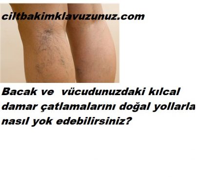 Read more about the article KILCAL DAMAR ÇATLAMALARINI DOĞAL YOLDAN YOK EDİN