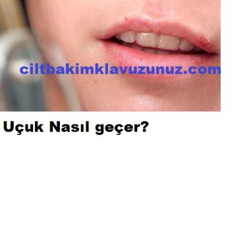 Read more about the article Uçuk Nedir Nasıl Geçer