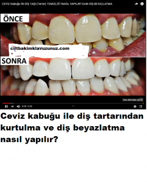 Read more about the article Dişlerdeki Tartar Ve Lekelere Son